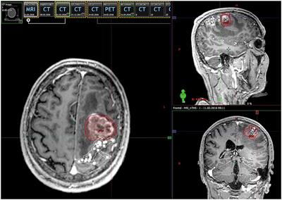 The Role of Navigated Transcranial Magnetic Stimulation Motor Mapping in Adjuvant Radiotherapy Planning in Patients With Supratentorial Brain Metastases